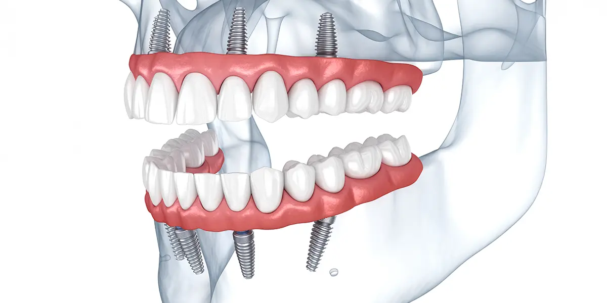 Impianti dentali - riabilitazione completa - Studio Associato Odontoiatria SAO - Chiaia, Posillipo - Napoli